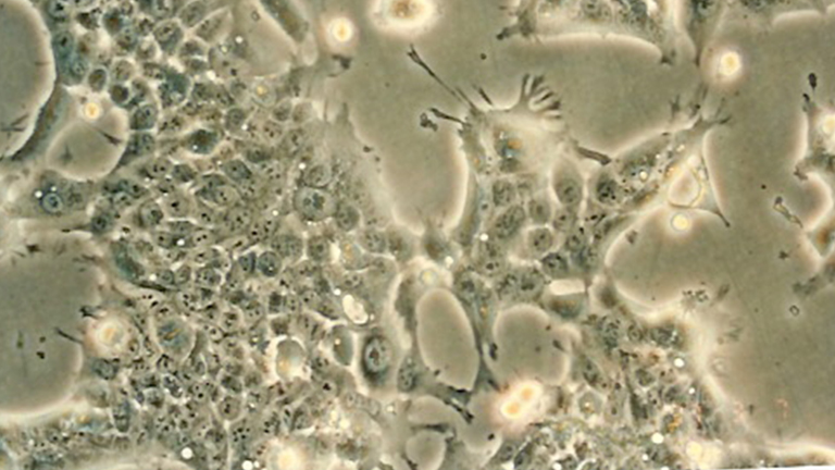 Detroit 562人咽頭癌胸水轉移細胞（STR鑒定正確）