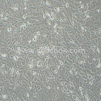 Marcus人星形膠質(zhì)細胞瘤（STR鑒定正確）